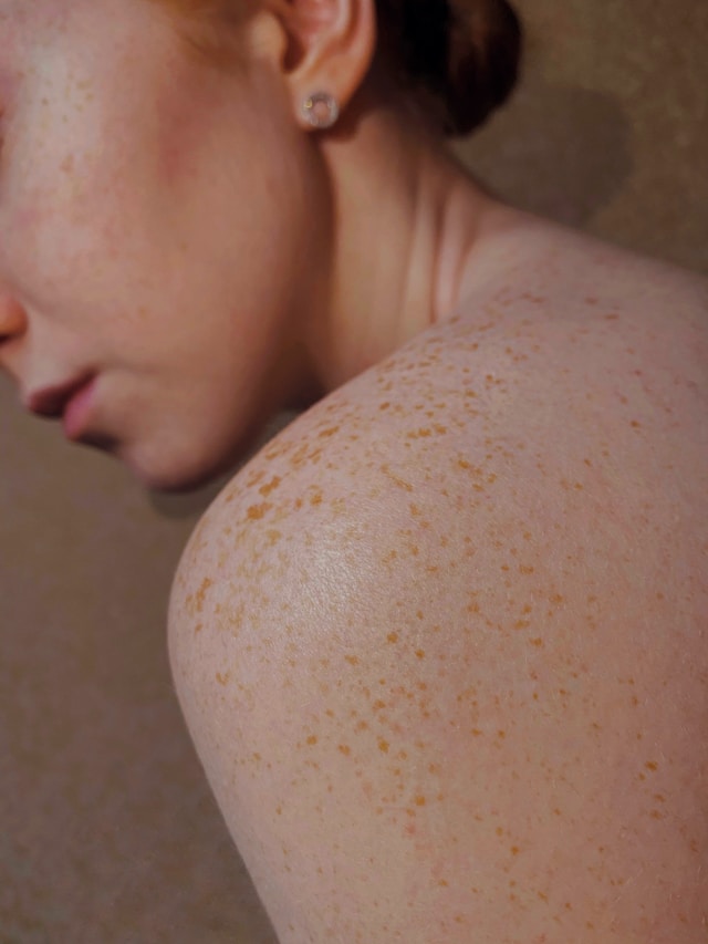 Die Rolle der Ernährung im Kampf gegen Melasma